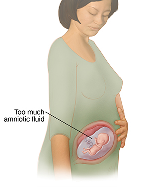 Three-quarter view of pregnant woman showing fetus in womb with too much amniotic fluid.
