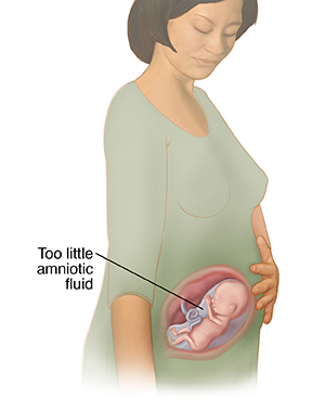 Three-quarter view of pregnant woman showing fetus in womb with too little amniotic fluid.