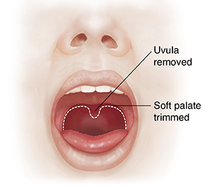 Front view of face showing sinuses and open mouth. Dotted line shows soft palate tissues to be removed.
