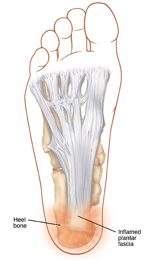 Bottom view of foot showing bones and inflamed plantar fascia.