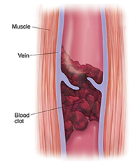 Cross section of muscle and varicose vein with blood clot.