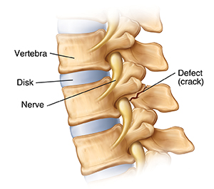 Side view of lumbar vertebrae with spondylolysis showing defect (crack) at back of one vertebra.