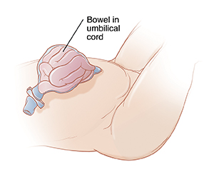 Closeup of infant abdomen showing bowel inside umbilical cord.
