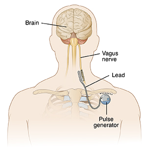 Front view of man's head and chest showing vagus nerve stimulation device implanted near collarbone.