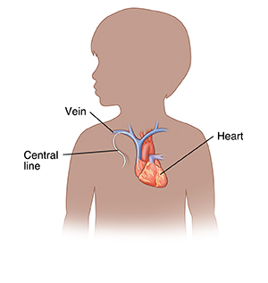 Outline of child showing a central line inserted into a vein.
