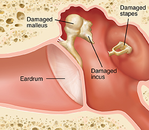Cross section of ear showing outer, inner, and middle ear structures with damaged malleus, incus, and stapes.
