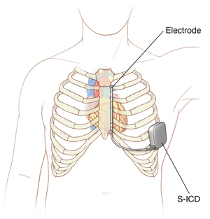 Front view of ribcage and heart showing an S-ICD placement. 