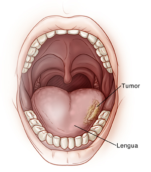Vista frontal de una boca abierta con un tumor en un lado de la lengua.