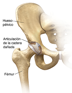 Vista frontal de la articulación de la cadera con artritis.