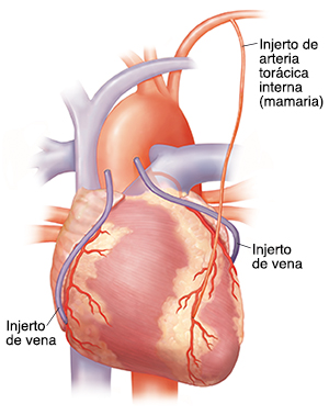 Vista frontal del corazón que muestra tres injertos de derivación en las arterias coronarias.