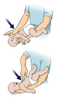 La maniobra por atragantamiento en un bebé tiene dos pasos.