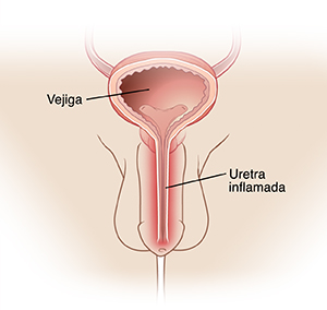 Vista frontal del pene y del escroto. Se ve el corte transversal de la vejiga justo sobre el pene con la uretra que sale de la vejiga a través del pene hacia el exterior. La uretra está inflamada (hinchada).