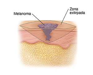 Capas de piel con melanoma que muestran las líneas de las incisiones para extirpar el tumor.