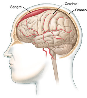 Vista lateral de una cabeza en la que puede verse un corte transversal en el cráneo donde se observa todo el encéfalo, con sangre entre el cerebro y el cráneo.
