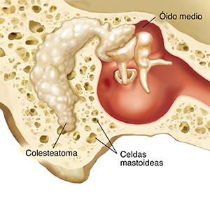 Corte transversal a través del hueso mastoideo y del oído medio que muestra colesteatoma.