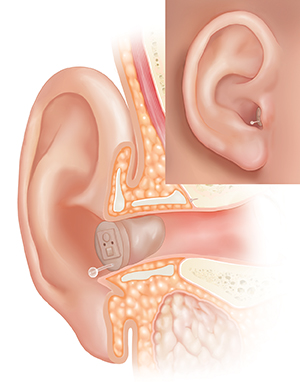 Corte transversal de un oído, donde pueden verse las estructuras del oído externo, interno y medio, con un audífono colocado completamente en el conducto auditivo y un recuadro que muestra la vista externa.
