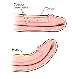 Corte transversal de un pene normal. Corte transversal de un pene curvado con enfermedad de la Peyronie.