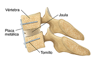 Corte transversal de las vértebras cervicales y de un disco con espaciador intervertebral y una placa con tornillos que las mantiene unidas.
