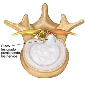 Vista superior de una vértebra lumbar y del disco dañado presionando los nervios.
