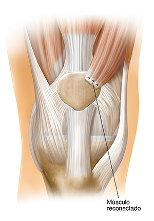 Vista frontal de una articulación de rodilla que muestra transferencia del cuádriceps.