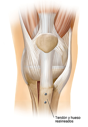 Vista frontal de una articulación de rodilla en donde se ve una realineación de la rótula.