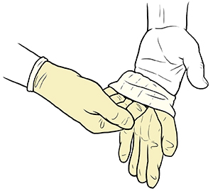 Mano enguantada que coloca el guante estéril sobre los dedos de la otra mano.