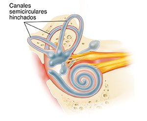 Oído interno que muestra mayor cantidad de líquido y de inflamación.