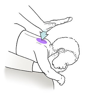 Primer plano de un adulto sosteniendo a un bebé boca abajo sobre su regazo y preparándose para darle un golpe entre los omóplatos con el talón de la mano.