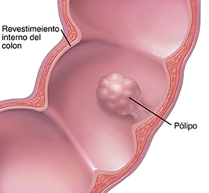 Corte transversal del colon con un pólipo.