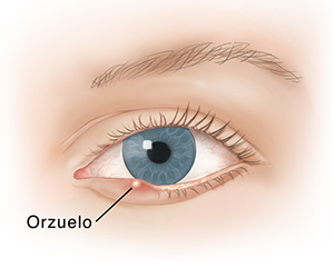Vista frontal de un ojo donde se observa un orzuelo en el párpado inferior.