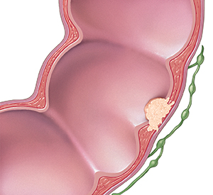 Corte transversal del colon y ganglios linfáticos, donde puede verse que el cáncer se propaga a través de la pared del colon pero no a los ganglios linfáticos.