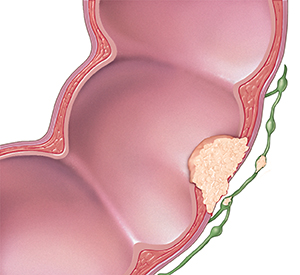 Corte transversal del colon y ganglios linfáticos, donde puede verse que el cáncer se propaga a través de la pared del colon y a los ganglios linfáticos.