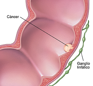 Corte transversal del colon y ganglios linfáticos, donde puede verse cáncer en el colon.