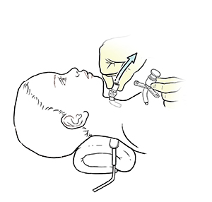 Niño acostado boca arriba con una almohada debajo del cuello. Una mano enguantada quita un tubo de traqueostomía ya usado del cuello del niño.
