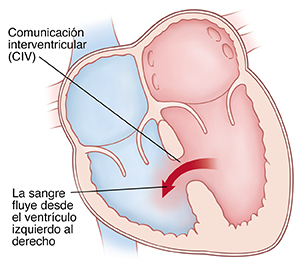 Corte transversal frontal de un corazón en donde se ve una comunicación interventricular (CIV) que permite que la sangre pase del ventrículo izquierdo al derecho.