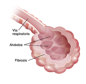 Primer plano de las vías respiratorias y los alvéolos con fibrosis.