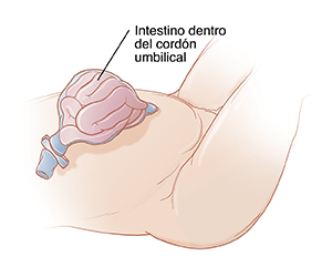 Primer plano de abdomen de bebé en donde se ve el intestino dentro del cordón umbilical.