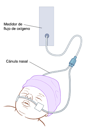Primer plano de la cabeza de un bebé con una cánula nasal debajo de la nariz.