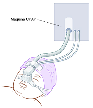 Primer plano de la cabeza de un bebé que muestra una mascarilla de CPAP.