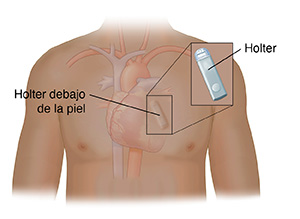 Vista frontal del pecho de una persona donde se observa el corazón y un Holter ubicado debajo de la piel por encima del corazón. En el recuadro se observa de cerca el Holter.