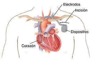Contorno del pecho de un hombre en el que puede verse un desfibrilador cardioversor implantable biventricular colocado con tres cables que van hacia las cámaras del corazón.