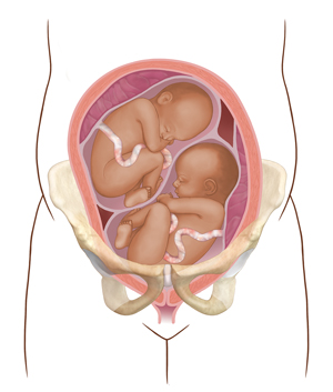 Vista frontal de un corte transversal de un útero en los huesos pélvicos donde se observan dos fetos.