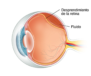 Corte transversal de tres cuartos de un ojo donde se observa el desprendimiento de retina.
