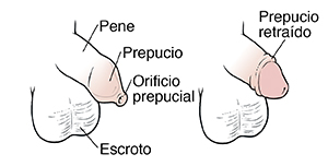 Vista lateral del pene de un niño y el escroto que muestra el prepucio del pene. Vista lateral del pene y el escroto de un niño que muestra el prepucio retraído.