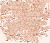 Ilustración que muestra células anormales que varían aún más en tamaño y en forma en el cáncer de próstata de grado 4 o 5.
