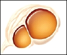 Cistoadenoma benigno