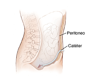 Vista lateral del abdomen donde puede verse un catéter insertado a través de la pared del cuerpo hacia el interior de la cavidad abdominal.
