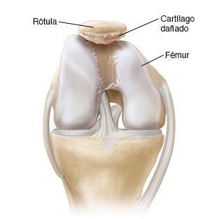 Vista frontal de una rodilla doblada en donde se ve daño del cartílago.