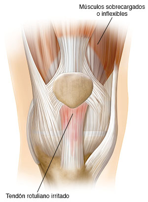 Vista frontal de una articulación de rodilla que muestra el tendón rotuliano inflamado.