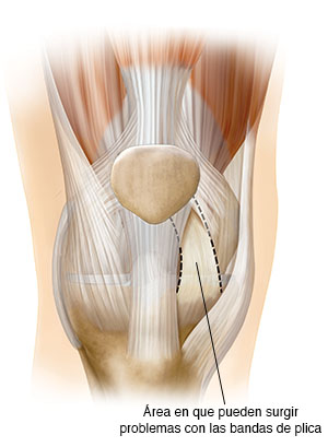 Vista frontal de una articulación de rodilla en donde se ve la plica sinovial.
